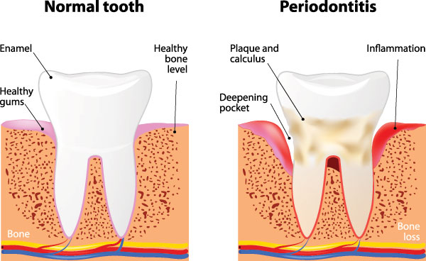 Davenport Dental Associates | Snoring Appliances, Fluoride Treatment and Dental Cleanings