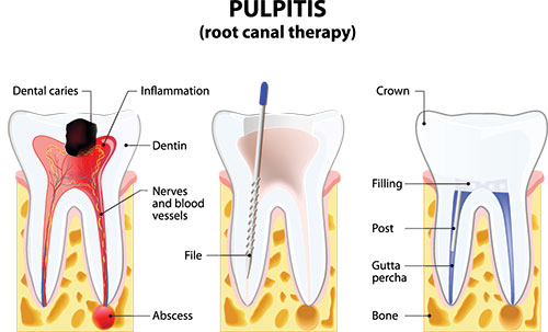 Davenport Dental Associates | Dental Sealants, Night Guards and Snoring Appliances